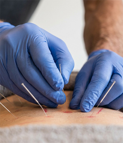 physical therapy with dry needling
